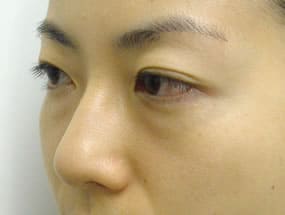 目の下のクマ・タルミ症例手術前