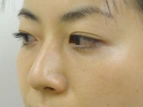目の下のクマ・タルミ症例手術３ヶ月後