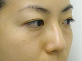 目の下のクマ・タルミ症例手術前