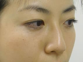 目の下のクマ・タルミ症例手術３ヶ月後