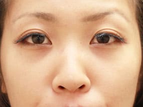 目の下のクマ・タルミ症例手術④手術３日後
