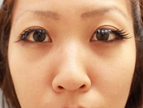 目の下のクマ・タルミ症例⑥手術２週間後