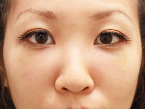 目の下のクマ・タルミ症例⑨手術１ヵ月