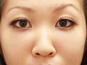 目の下のクマ・タルミ症例⑩手術１ヵ月