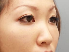 目の下のクマ・タルミ症例⑩-２手術１ヵ月