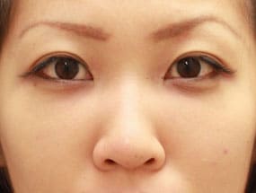 目の下のクマ・タルミ症例⑪手術１ヵ月