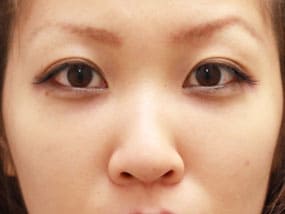 目の下のクマ・タルミ症例⑫手術１ヵ月