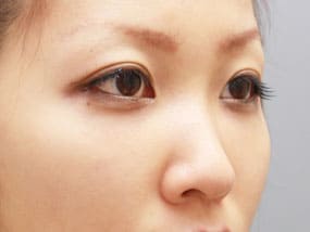 目の下のクマ・タルミ症例⑫-２手術１ヵ月