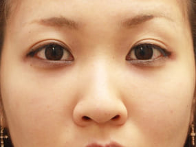 目の下のクマ・タルミ症例⑭手術３ヵ月後