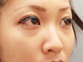目の下のクマ・タルミ症例①-２手術前