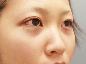 目の下のクマ・タルミ症例手術２週間後