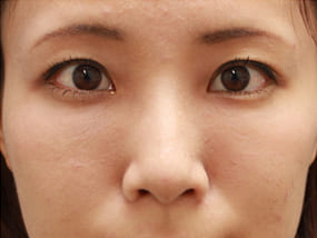 目の下のクマ・タルミ症例⑭