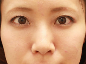 目の下のクマ・タルミ症例⑮