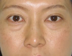 目の下のクマ・タルミ症例手術前