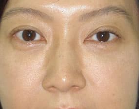 目の下のクマ・タルミ症例手術３ヶ月後