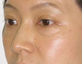 目の下のクマ・タルミ症例手術前