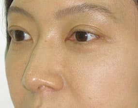 目の下のクマ・タルミ症例手術３ヶ月後