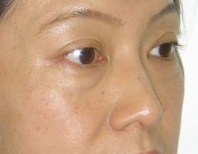 目の下のクマ・タルミ症例手術前