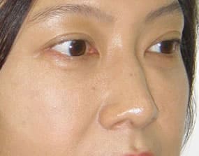 目の下のクマ・タルミ症例手術３ヶ月後