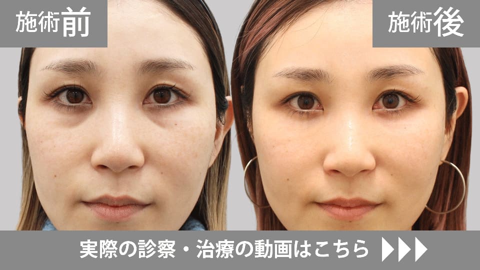 目の下のくま・たるみ取りモニター症例動画№01
