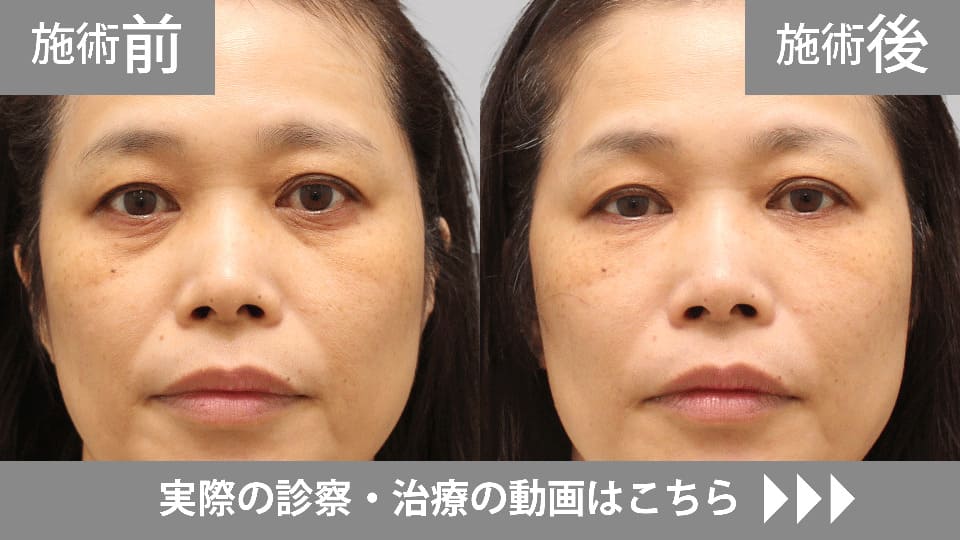 目の下のくま・たるみ取りモニター症例動画№02