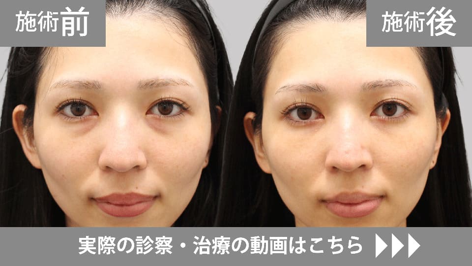 目の下のくま・たるみ取りモニター症例動画№05