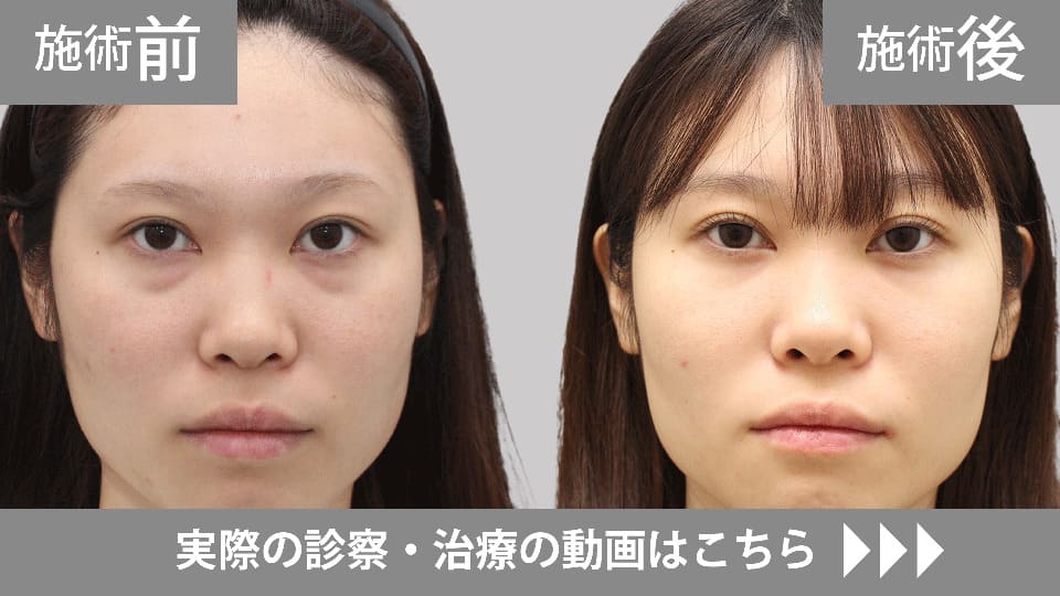 目の下のくま・たるみ取りモニター症例動画№06