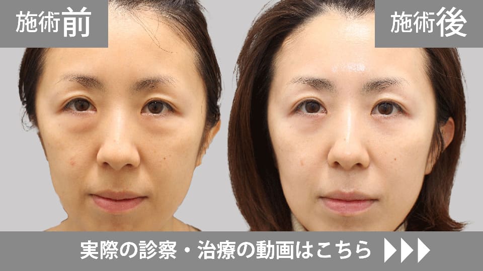 目の下のくま・たるみ取りモニター症例動画№09