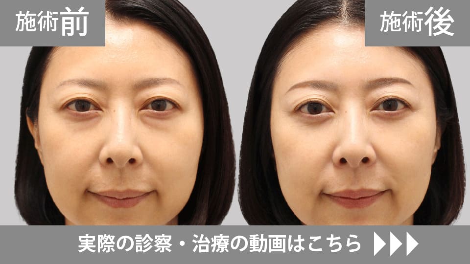 目の下のくま・たるみ取りモニター症例動画№11