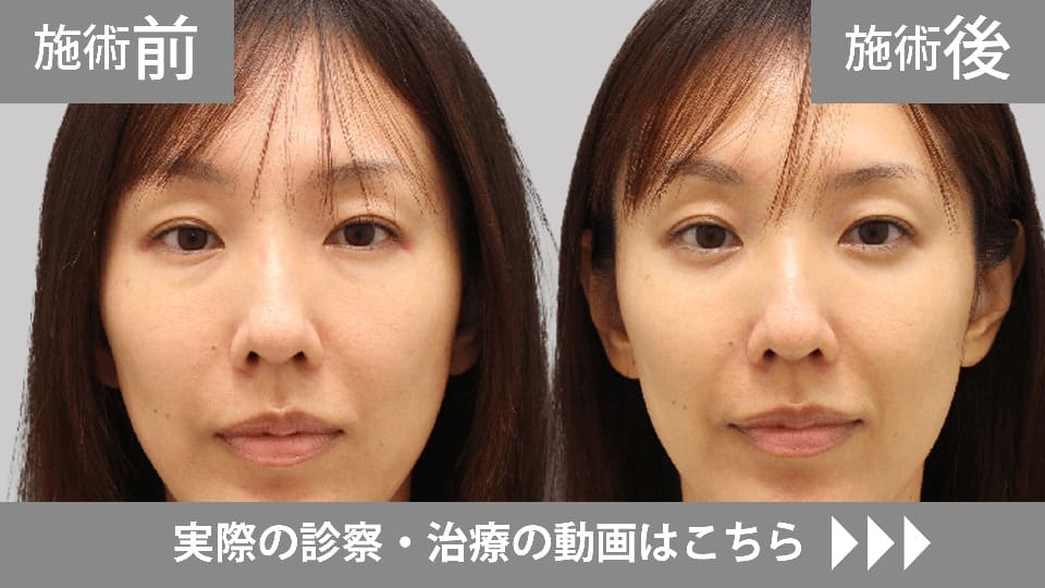 目の下のくま・たるみ取りモニター症例動画№12