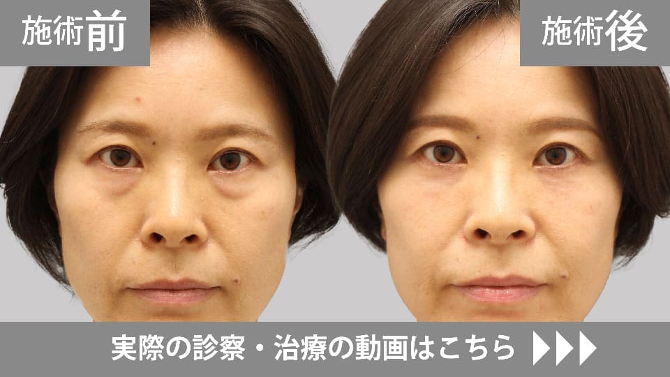 目の下のくま・たるみ取りモニター症例動画№13