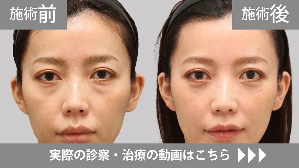 目の下のくま・たるみ取りモニター症例動画№14