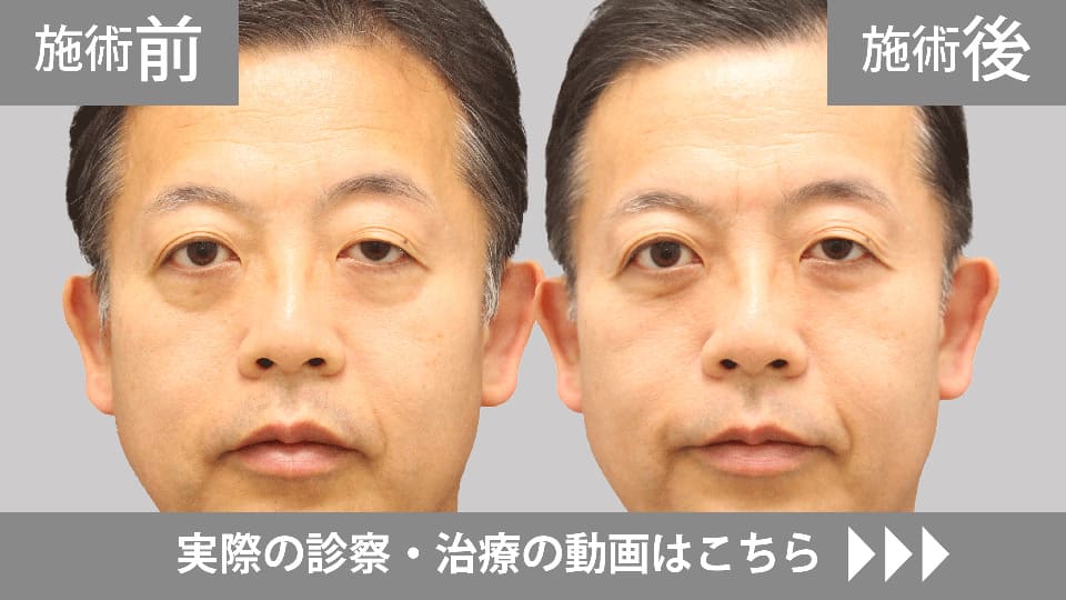 目の下のくま・たるみ取りモニター症例動画№15