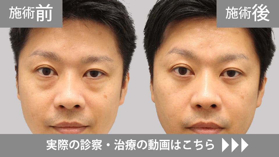 目の下のくま・たるみ取りモニター症例動画№16