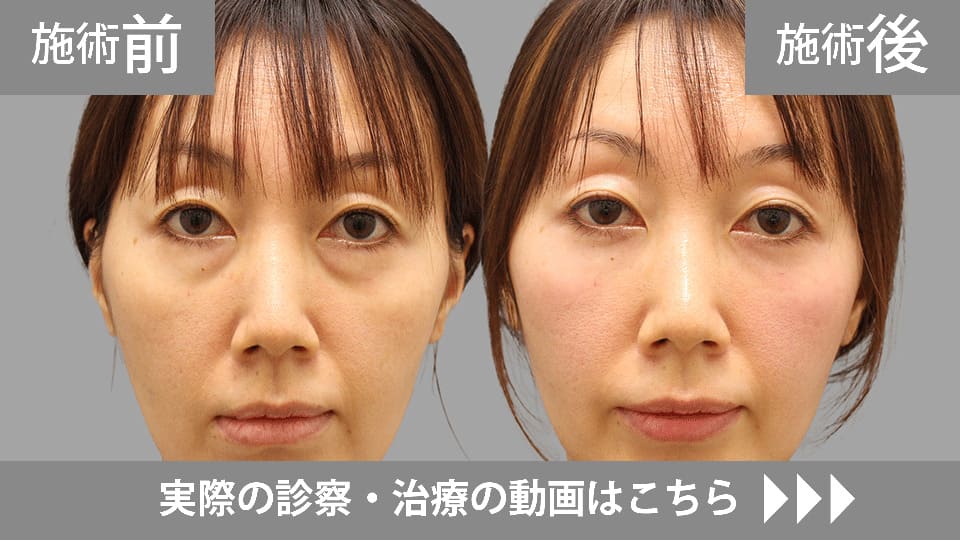 目の下のくま・たるみ取りモニター症例動画№19