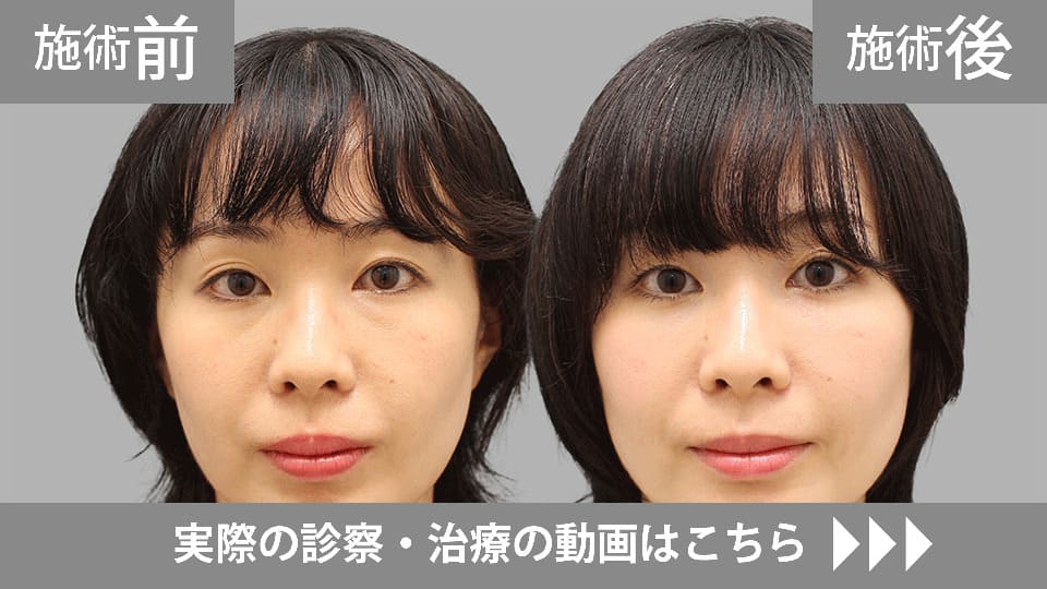 目の下のくま・たるみ取りモニター症例動画№21