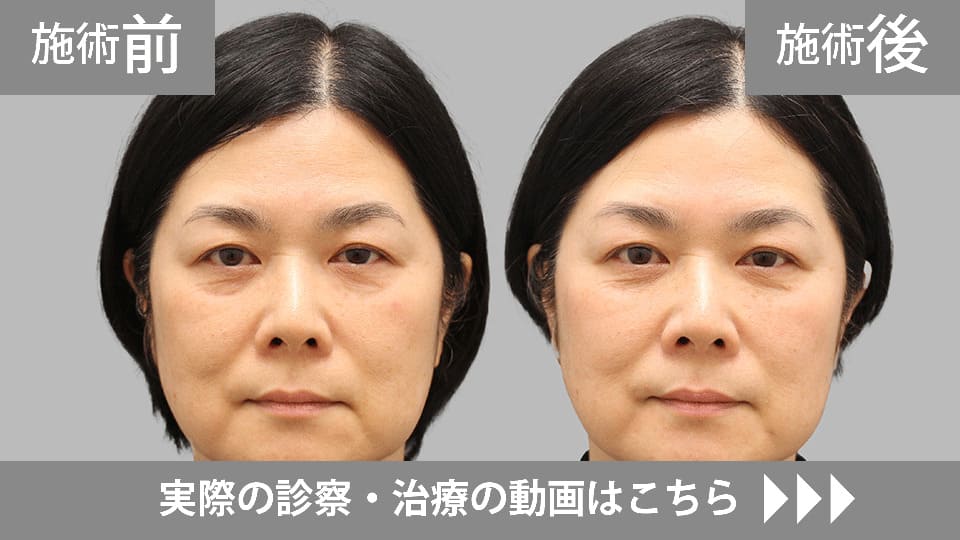 目の下のくま・たるみ取りモニター症例動画№22
