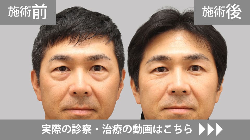 目の下のくま・たるみ取りモニター症例動画№23