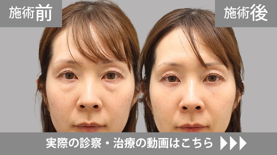 目の下のくま・たるみ取りモニター症例動画№24
