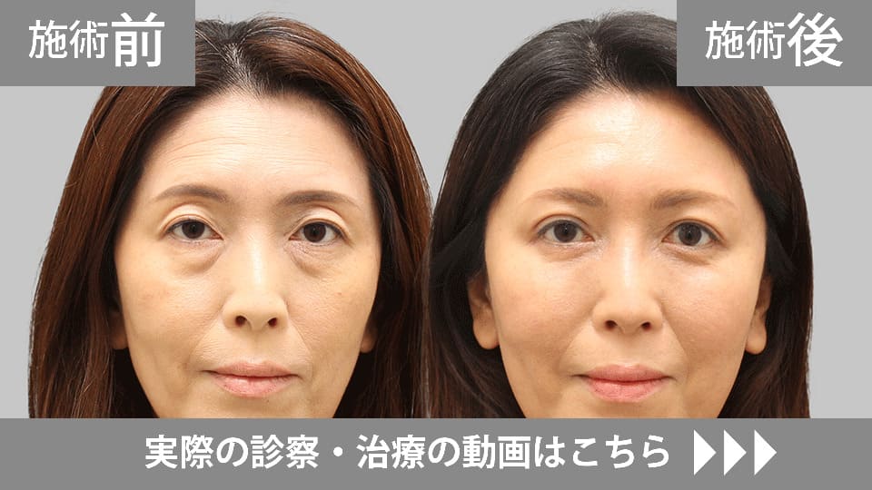 目の下のくま・たるみ取りモニター症例動画№25