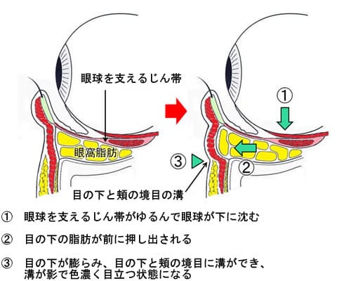 目の下の眼窩脂肪が押し出されるメカニズム