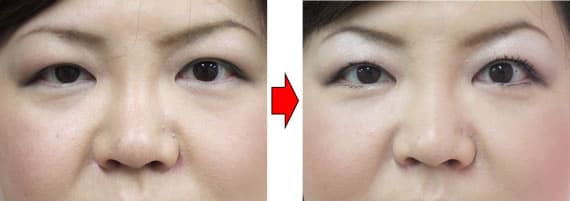 眼窩脂肪が飛び出して下まぶたが膨らみと眼頬溝と影ぐまを経結膜脱脂法で治療した症例