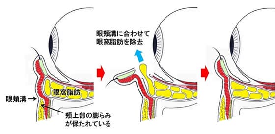 眼頬溝・眼窩脂肪・頬上部の膨らみが保たれている状態から眼頬溝に合わせて眼窩脂肪を除去（イラスト）