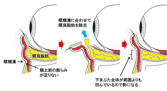 眼頬溝・眼窩脂肪・頬上部の膨らみが足りない状態から眼頬溝に合わせて眼窩脂肪を除去。下まぶた全体が周囲よりも凹んでいるので影になる（イラスト）