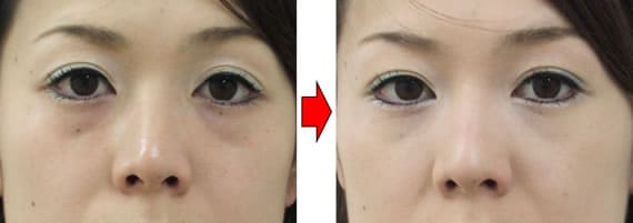 経結膜脱脂法の手術（手術前に左右両側の眼頬溝に軽度の凹みが認められた症例）