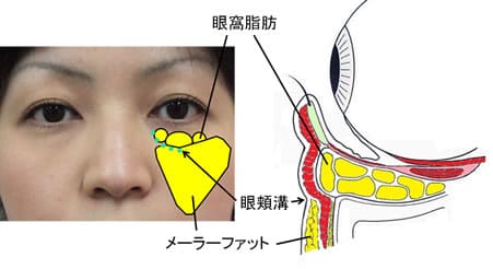 眼窩脂肪と眼頬溝、メーラーファットに関する説明（症例画像とイラスト）