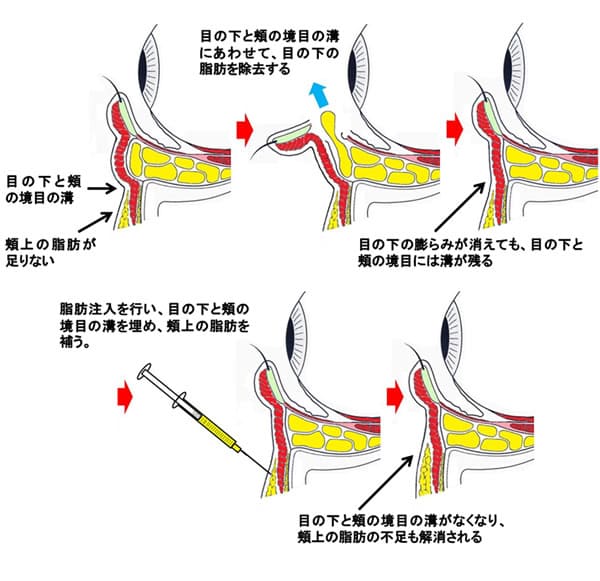 脱脂リポ法・脱脂コンデンスリポ法の手術概要（イラスト）