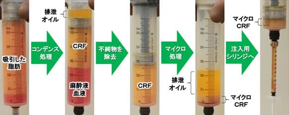 脂肪調整機器は不純物を確実に除去し有用な脂肪細胞と脂肪幹細胞だけを濃縮することが出来ます。この濃縮された脂肪がコンデンスリッチファット（ＣＲＦ）です。
