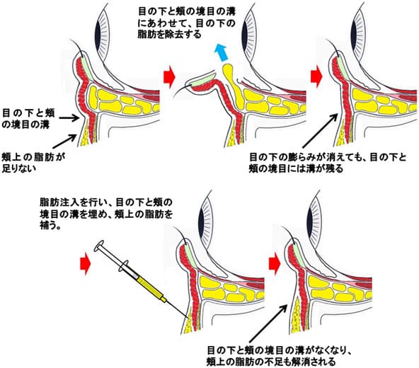 マイクロＣＲＦの注入における治療概要（イラスト）