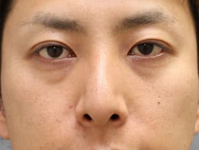 手術前（正面）